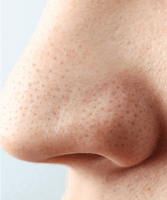 Blackheads