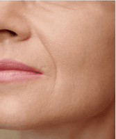 Wrinkles