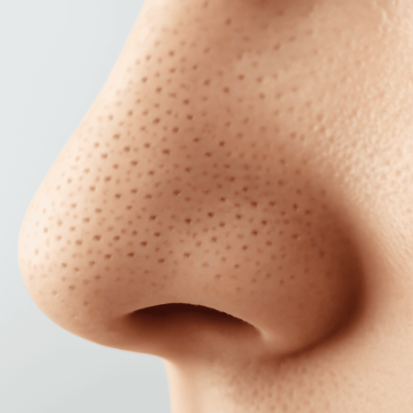 Blackheads